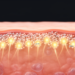 CXCR4 emerges as a dermal immune signal hub in psoriasis, single-cell and spatial study finds