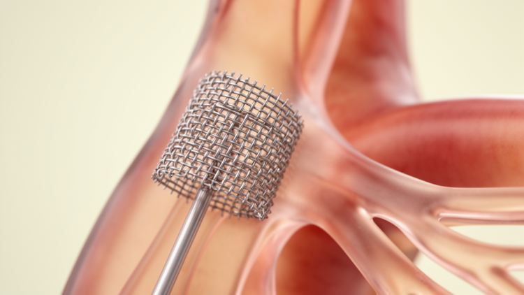 Fifteen Years of Subclavian Artery Occlusion Devices Have Not Yet Proven Better Outcomes