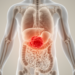 Tumour location shapes survival in rare leiomyosarcoma, study of 11,700 patients finds