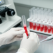 Negative Coombs Test Does Not Exclude Immune Anemia