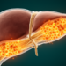 Iron paradox found in primary sclerosing cholangitis patients