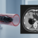 Embolism-cast CT tracking shows Obsidio gel shrinking as radiodensity rises