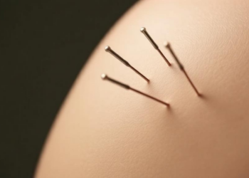Fake Needles, Real Relief: Sham Acupuncture Triggers Strong Placebo Response in IBS Patients