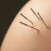 Fake Needles, Real Relief: Sham Acupuncture Triggers Strong Placebo Response in IBS Patients