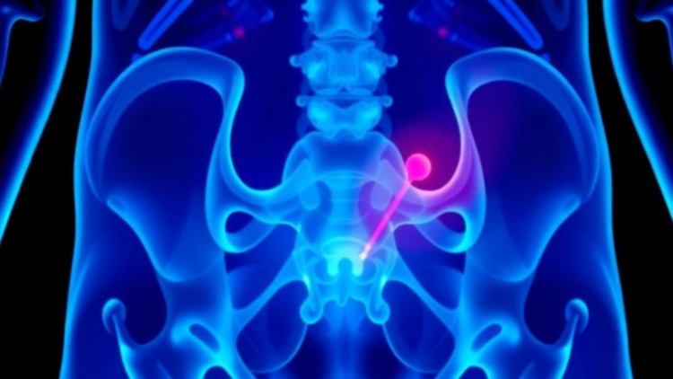 Doctors Report an Ultra-Rare Scrotal Cancer That Struck With No Known Risk Factors