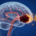 Traumatic Venous Sinus Thrombosis: Anticoagulation Benefit Remains Uncertain in 14-Year Study