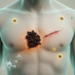 UK study maps treatment patterns and outcomes in loco-regional recurrent melanoma