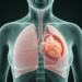 Rare Chest-Only High-Grade Serous Carcinoma Reported in 60-Year-Old Woman