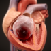 Rare Balloon-Like Cardiac Myxoma Mimicked a Blood-Filled Cyst