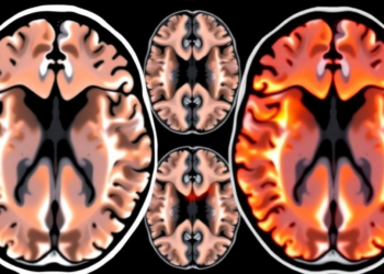 AI Models Face Off in Head-to-Head Test for Spotting Stroke Damage on Routine Brain Scans