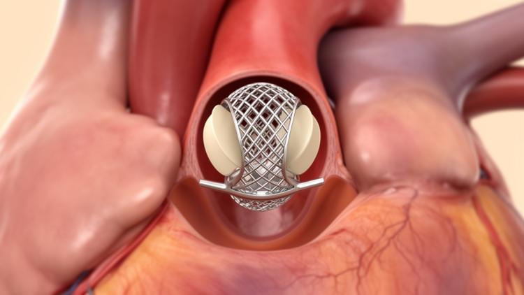 Valve Migration After TAVR Unmasked Hidden Behçet Disease in One Patient