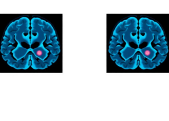How a Brain Lymphoma Responds to Steroids on MRI May Predict Survival