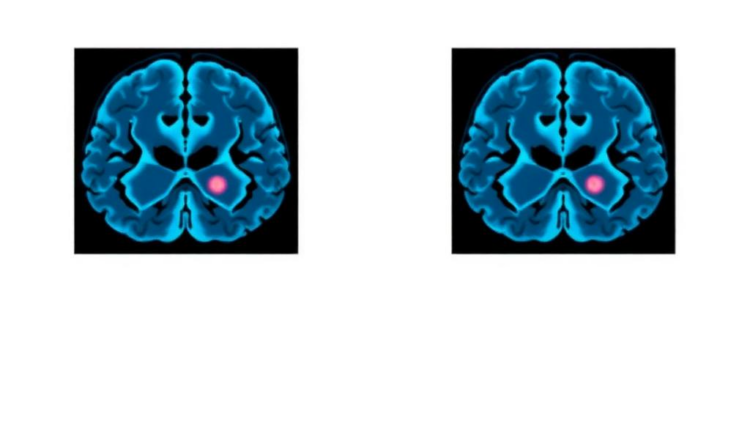 How a Brain Lymphoma Responds to Steroids on MRI May Predict Survival