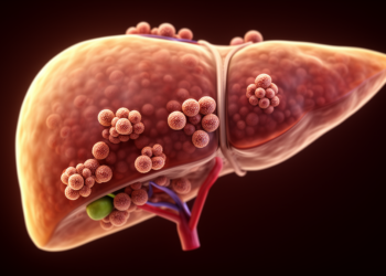Immune structures inside liver tumours linked to better immunotherapy outcomes