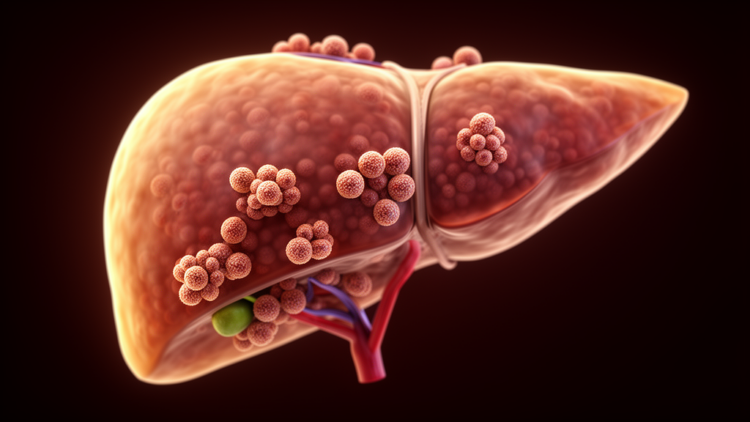 Immune structures inside liver tumours linked to better immunotherapy outcomes
