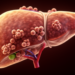 Immune structures inside liver tumours linked to better immunotherapy outcomes