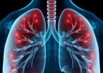 Breath Test Spots Lung Cancer With Over 90% Accuracy in Landmark Trial