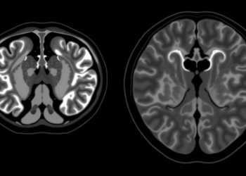 PSMA PET MRI Spots Prostate Cancer Recurrence in a Quarter of Men Right at the Start of Biochemical Relapse