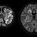 PSMA PET MRI Spots Prostate Cancer Recurrence in a Quarter of Men Right at the Start of Biochemical Relapse