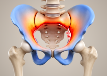 Severe labral tears in dysplastic hips concentrate stress in the upper acetabulum