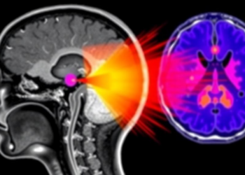 MRI-Based Centiloid Methods Prove Most Reliable for Amyloid PET Scoring