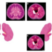 Rare SWI/SNF-Deficient Sinonasal Carcinomas Characterized in 10-Case Study