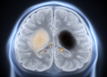 MRI reveals nigrosome-1 neuromelanin and iron changes in Parkinson disease