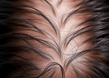 Hair Loss Signals Emerge in FDA Database as Biologics Draw New Safety Scrutiny