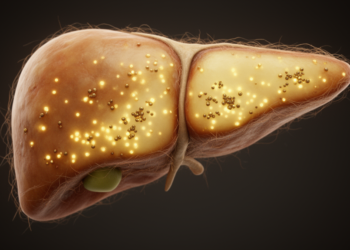 Iron Levels Shift in Fatty Liver Disease, but Fibrosis Link Stays Unclear