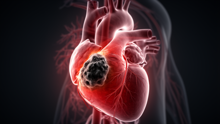 Cardiac sarcoma: new diagnostic framework proposed from two rare left atrial cases