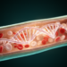 DNA Methylation Score Sharpens Leukemia Risk Prediction in MDS