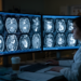 CT venous-phase radiomics models distinguish early from advanced gastric cancer before surgery