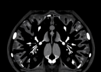 AI Diffusion Models Erase Truncation Artifacts from Cone-Beam CT Scans