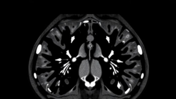 AI Diffusion Models Erase Truncation Artifacts from Cone-Beam CT Scans