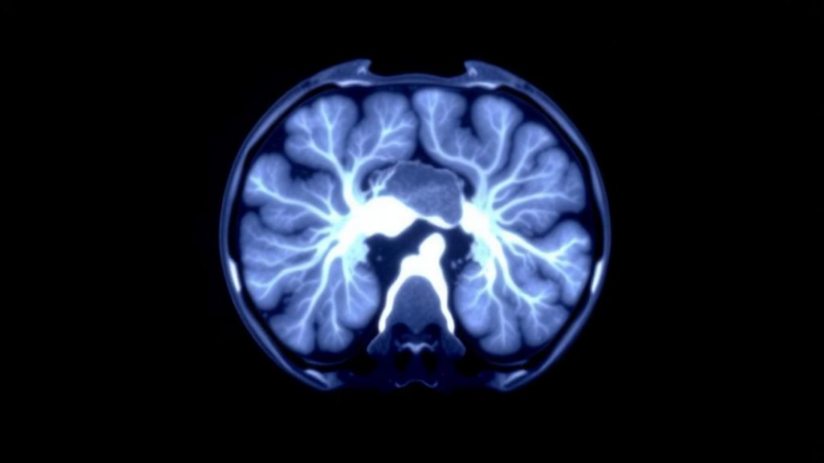PET Scan Glucose Uptake Offers Clues to Immunotherapy Biomarker in Esophageal Cancer