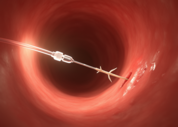 Doctors Use Ultrasound Inside a Vein to Pull a Swallowed Fish Bone Out of the Inferior Vena Cava