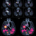 MRI Scans Reveal Hidden Cell Neighborhoods That May Signal Breast Cancer Spread