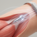 Wireless magnetic implants track muscle movement through skin
