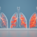 Three lung inflammation sub-phenotypes in pneumonia may reshape critical care treatment