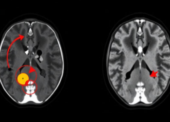 Shortened Liver MRI Protocol Shows Strong Accuracy for Spotting Tumor Return After Ablation