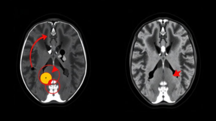 Shortened Liver MRI Protocol Shows Strong Accuracy for Spotting Tumor Return After Ablation