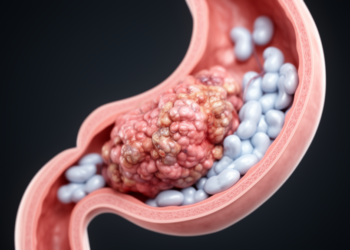 Research report: Esophageal adenosquamous carcinoma with mucinous carcinoma-predominant lymph node metastases: a case report