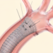 Needle-Fenestrated Stent-Graft Repair of the Aortic Arch Shows Durable Early Results