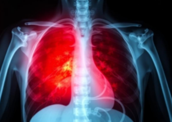 As Immunity Falls, Tuberculosis in HIV Wears a Different Face on the Chest X-Ray