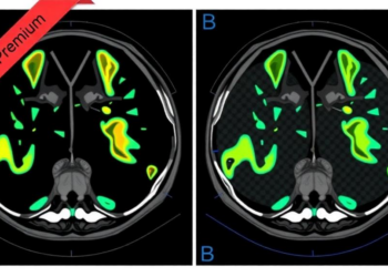 Threshold-Based Segmentation Outperforms Gradient Methods for Tracking Tumour Volume on Lu-177 PSMA SPECT/CT