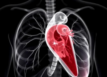 Rheumatic Mitral Stenosis in Ethiopian Children: Severe Disease, High Mortality