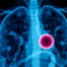 Benign Tumor at a Lung Surgery Port Site Fooled Doctors Into Fearing Cancer Recurrence