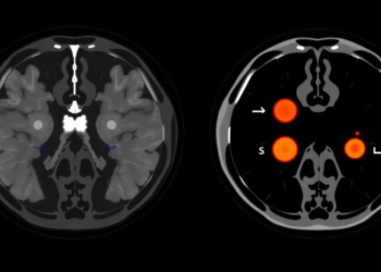PET/CT Scans After CAR T-Cell Therapy Track Response in Korean Lymphoma Patients