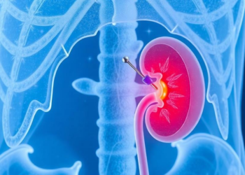 Freezing Kidney Tumors With Needles Shows Five-Year Success Against Papillary Renal Cancer