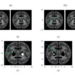 Ensemble AI Reads Brain MRI With Adaptive Attention and Statistical Rigor